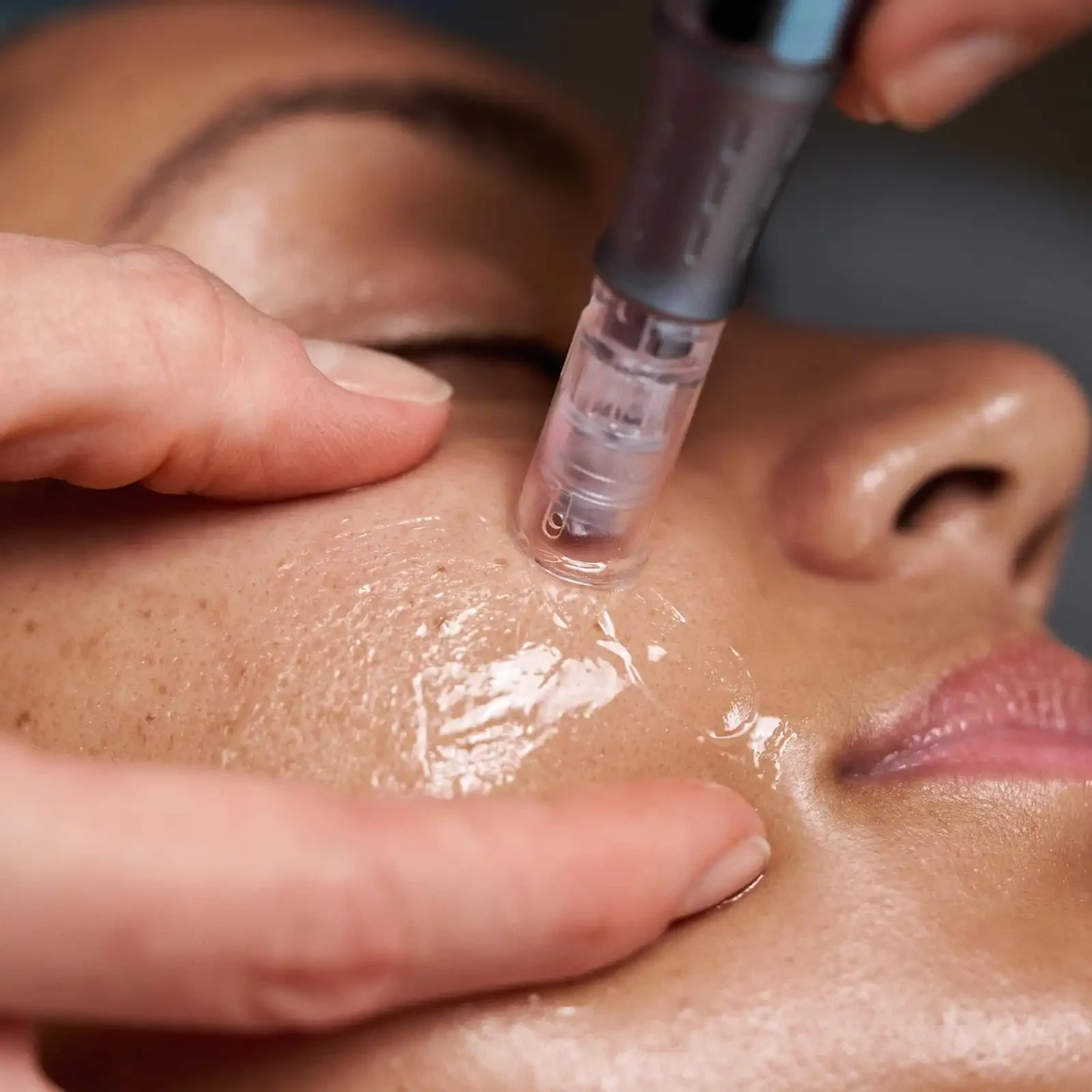 Microneedling treatment